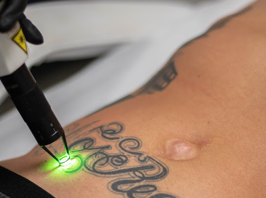 Combined Picosecond Laser Tattoo Removal with an Acoustic Shock Wave  Device A Case Series  Clinical Case Reports Journal ISSN 27670007